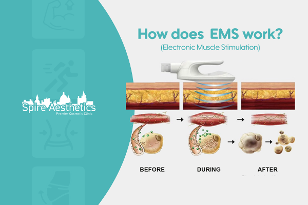 EMS treatment for post pregnancy weight loss treatment Sandwich