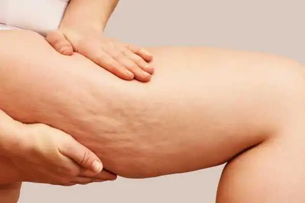 Image of woman showing leg with cellulite Sandwich
