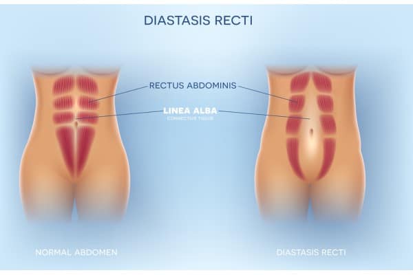 What Non-Surgical Options Are Available for Diastasis Recti Sandwich?