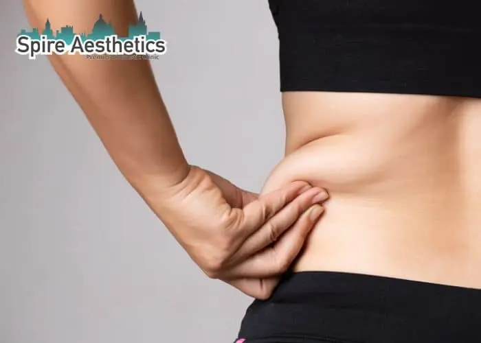 Image of woman pinching fat on their hips Sandwich. Fat Freezing treatment