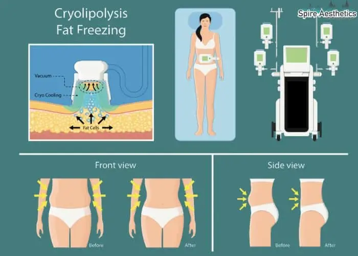 Fat freezing treatment Sandwich benefits for competitions to remove stubborn fat deposits.