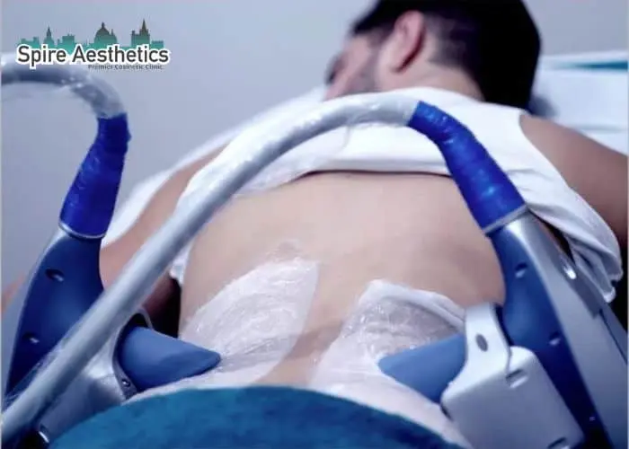 Man having fat freezing treatment done on love handles before a competitions Sandwich to create a sculpted look.