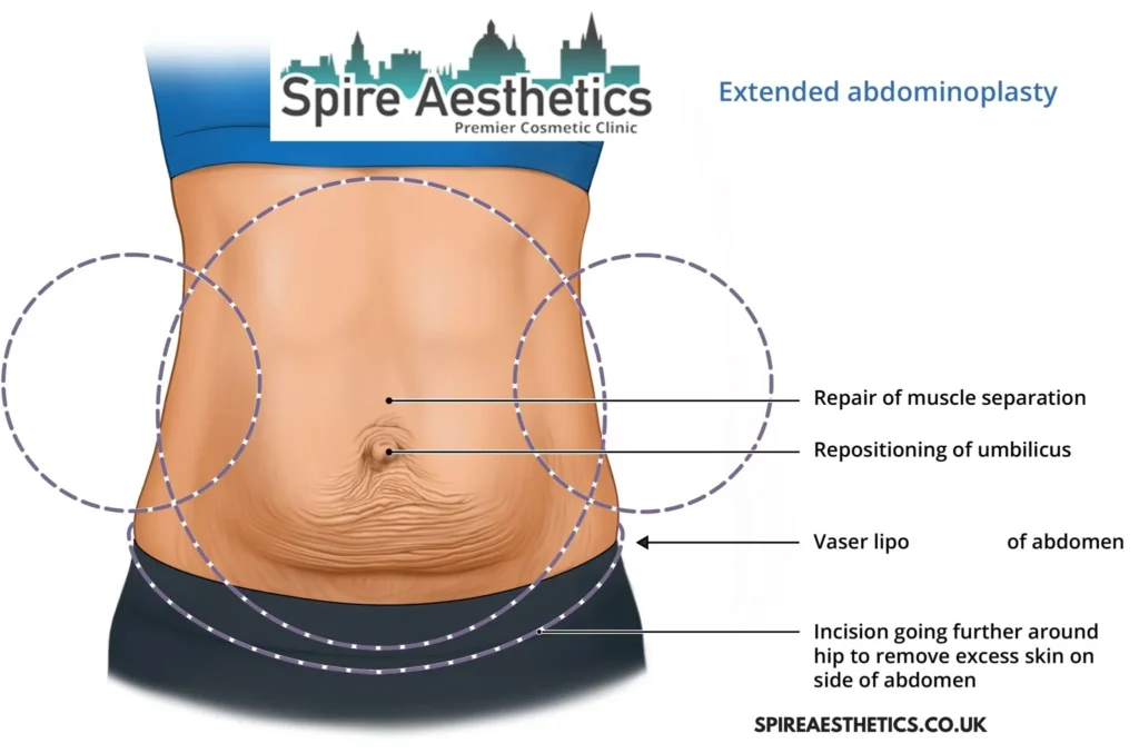 Understanding Loose Skin After Gastric Band Sandwich Surgery and HIFU Treatment