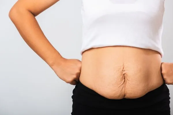 Image of a woman's stomach after weight loss with sagging skin following a gastric band Sandwich