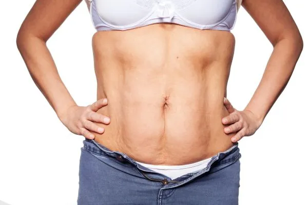 sagging skin on woman's stomach after weight loss injections Sandwich