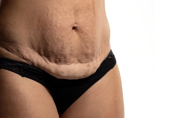 Image of womans stomach after weight loss injections Sandwich showing saggy skin
