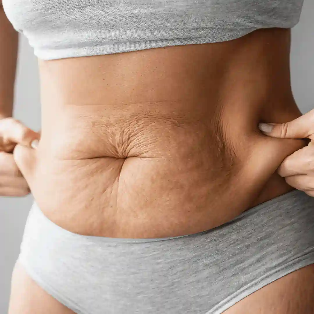 Is It Normal to Have Loose Skin After Pregnancy Sandwich?