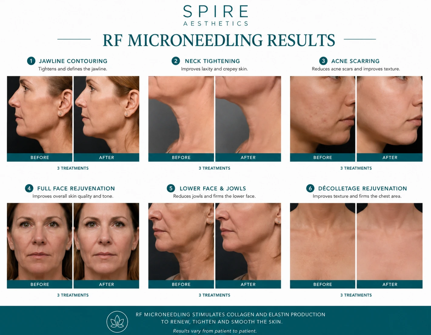 RF Microneedling Skin tightening Sandwich results