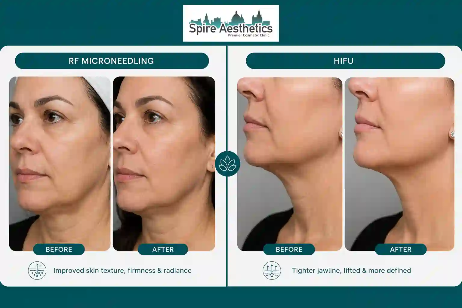 Can RF Microneedling and HIFU Be Combined Sandwich?