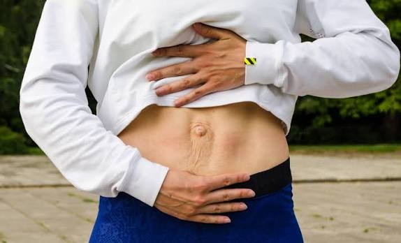 When Could Diastasis Recti Be the Missing Piece of the Puzzle Sandwich?
