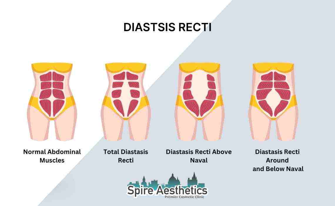Is Non-Surgical Diastasis Recti Treatment Right for You? Common Concerns Answered Sandwich